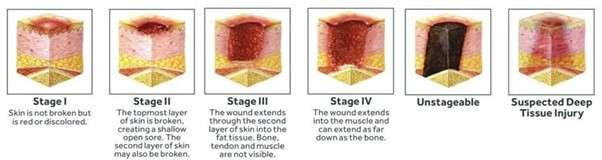 <p>PP: areas of pressure+limited mobility→decubitus ulcers</p><p>E: localized pressure→impaired blood supply<br>sacrum<br>lip</p><p>CM/DX:<br><u>stage 1:</u> nonblanching erythema of intact skin</p><p><u>stage 2:</u><br>necrosis<br>superficial/partial thickness<br>epidermis<br>±dermis<br>shallow ulcer</p><p><u>stage 3:</u><br>deep necrosis<br>crater ulcer<br>full thickness skin loss<br>damage/necrosis<br>no fascia involvement</p><p><u>stage 4:</u><br>full-thickness ulceration<br>extensive damage+necrosis to muscle/bone/supporting structures</p><p>TX:<br>NP: prophx<br>repositioning<br>massaging<br>minimize friction</p><p><u>ulcer:</u><br>moist sterile gauze<br>surgical debridement</p><p>MX: only if sx of infection are present<br>topical abx<br>PO abx</p><p>C: osteomyelitis<br>bacteremia</p>