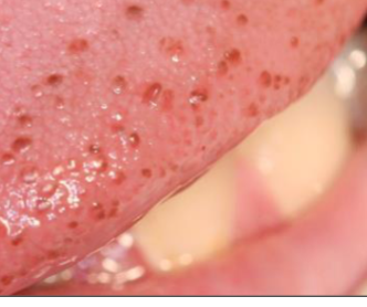 <p>brown discoloration of fungiform papillae, more common in DARKER SKIN individuals </p>