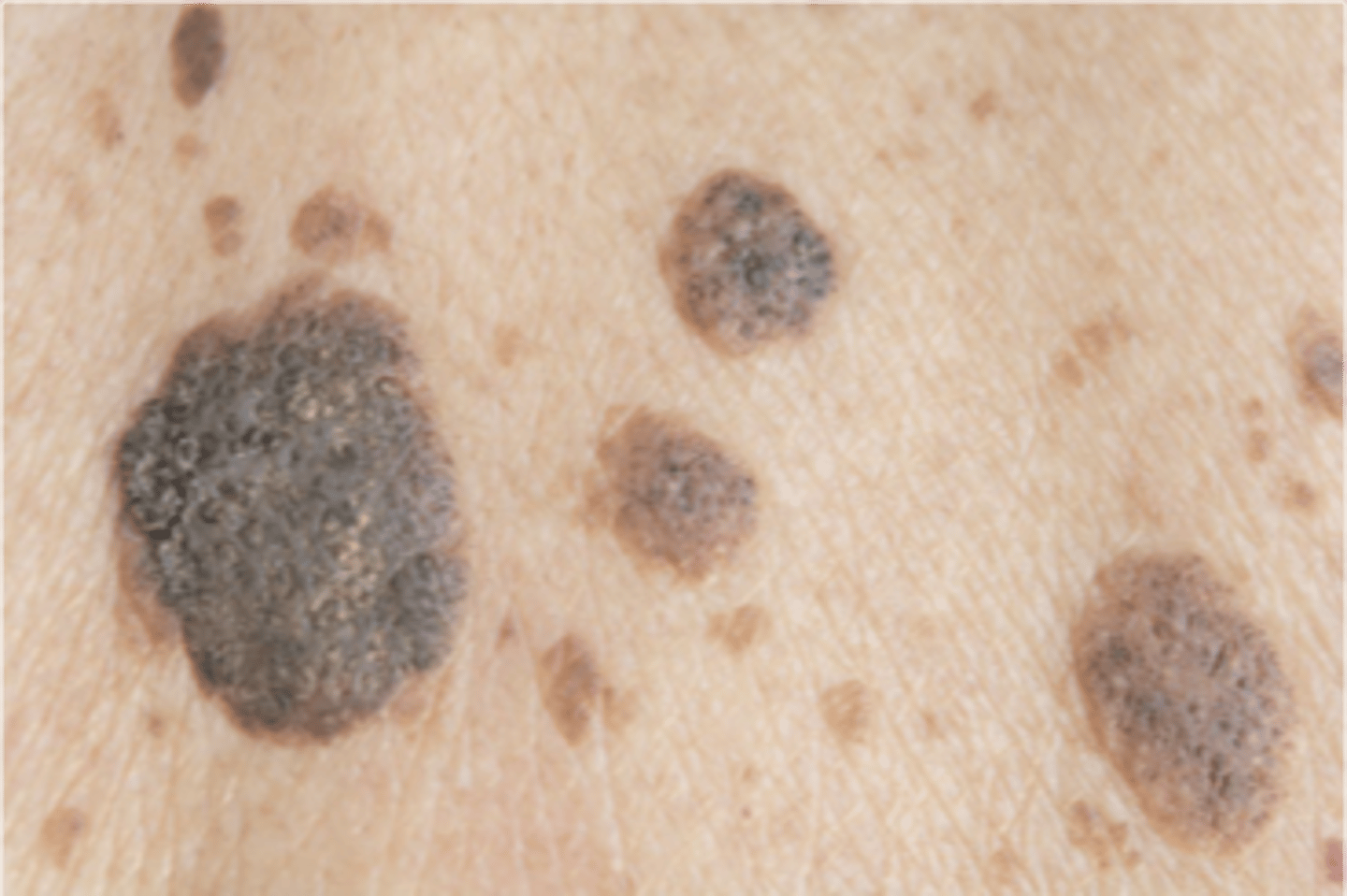 <p>name this skin pathology</p>