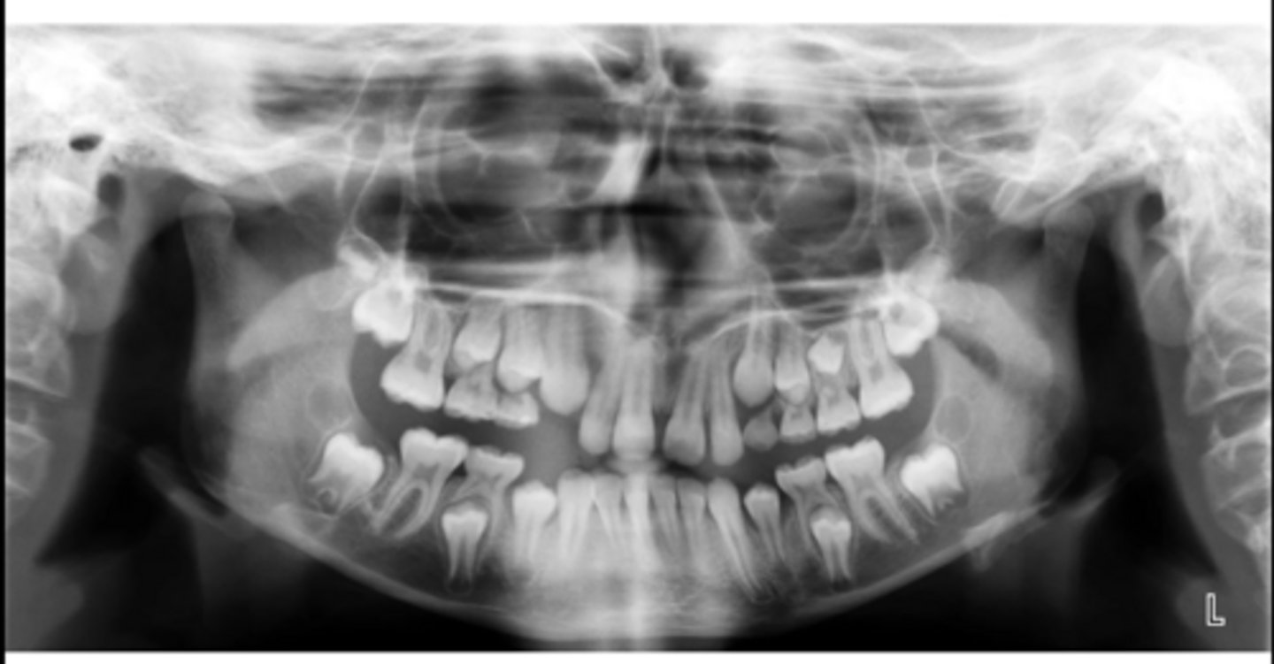 <p>What abnormalities/concerns do you see in this pano?</p>