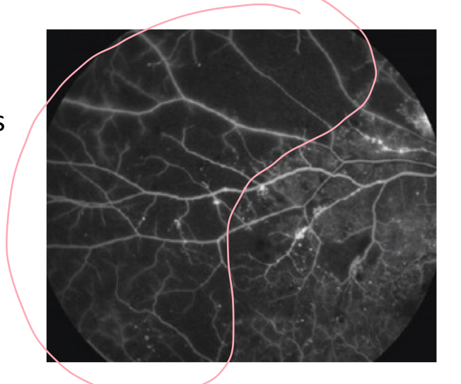 <p>hypofluorescence (filling defect) due to loss of retinal capillaries</p>