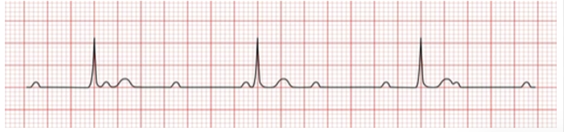 <p>what is 3rd DEGREE (COMPLETE) HEART BLOCK</p>