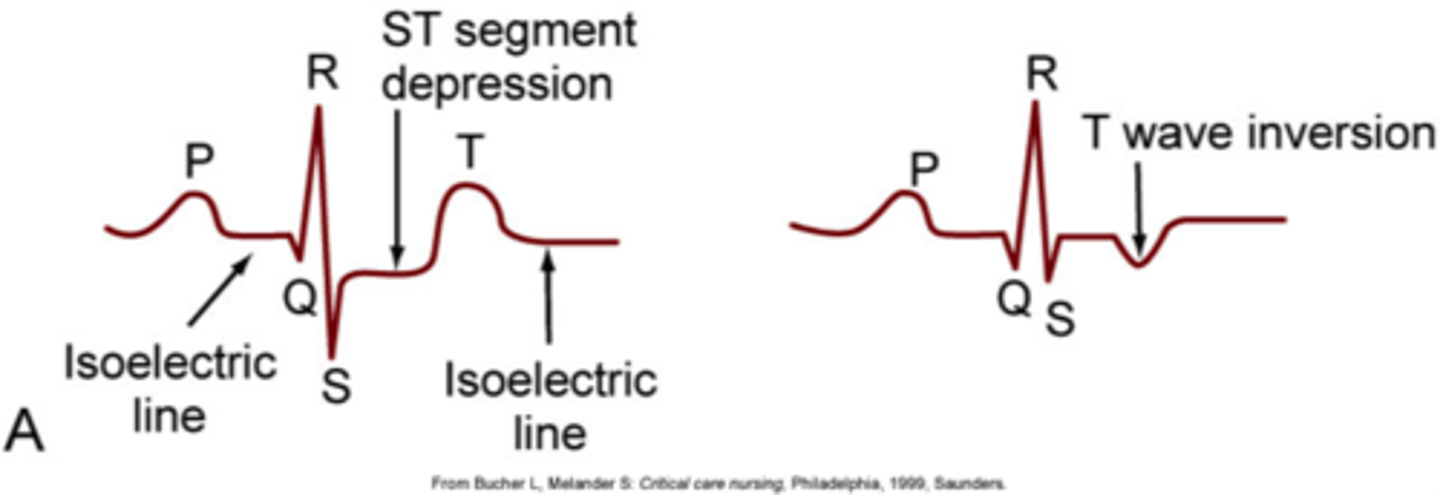 <p>Inverted T waves, ST segment depression; precordial leads (V1-V6) due to their position nearest to the ventricles, but any lead can be used</p>