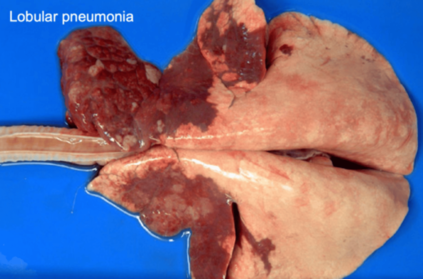 <p>this lobular pneumonia will likely be resolved in what way?</p>