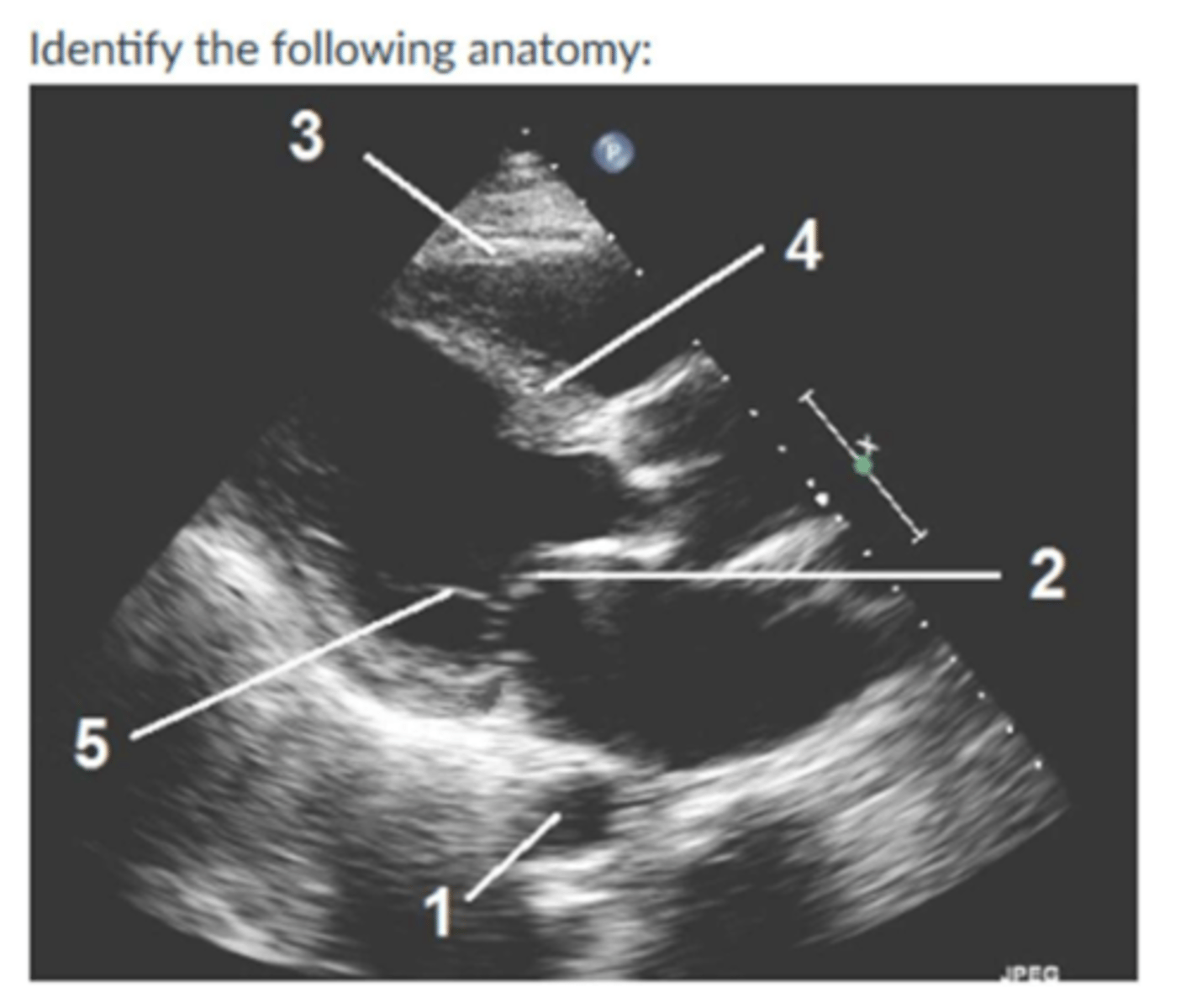 <p>1. DTA</p><p>2. Anterior mitral leaflet</p><p>3. Right ventricular</p><p>4. Interventricular</p><p>5. Chordae Tendinea</p>