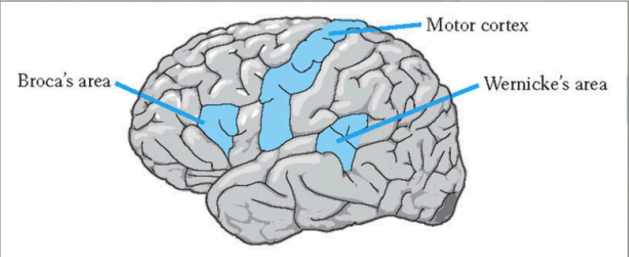 <ul><li><p>Location: Damage to Wernicke’s area in temporal lobe, left hemisphere.</p></li><li><p>Symptoms:</p><ul><li><p>Fluent but nonsensical speech (“word salad”).</p></li><li><p>Poor comprehension → cannot follow simple commands (e.g., “Touch your knee”).</p></li><li><p>Speech sounds normal in rhythm, but lacks meaningful content.</p></li></ul></li><li><p>Analogy:</p><ul><li><p>Like hearing a foreign language → speech flows but meaning is lost.</p></li></ul></li></ul><p></p>