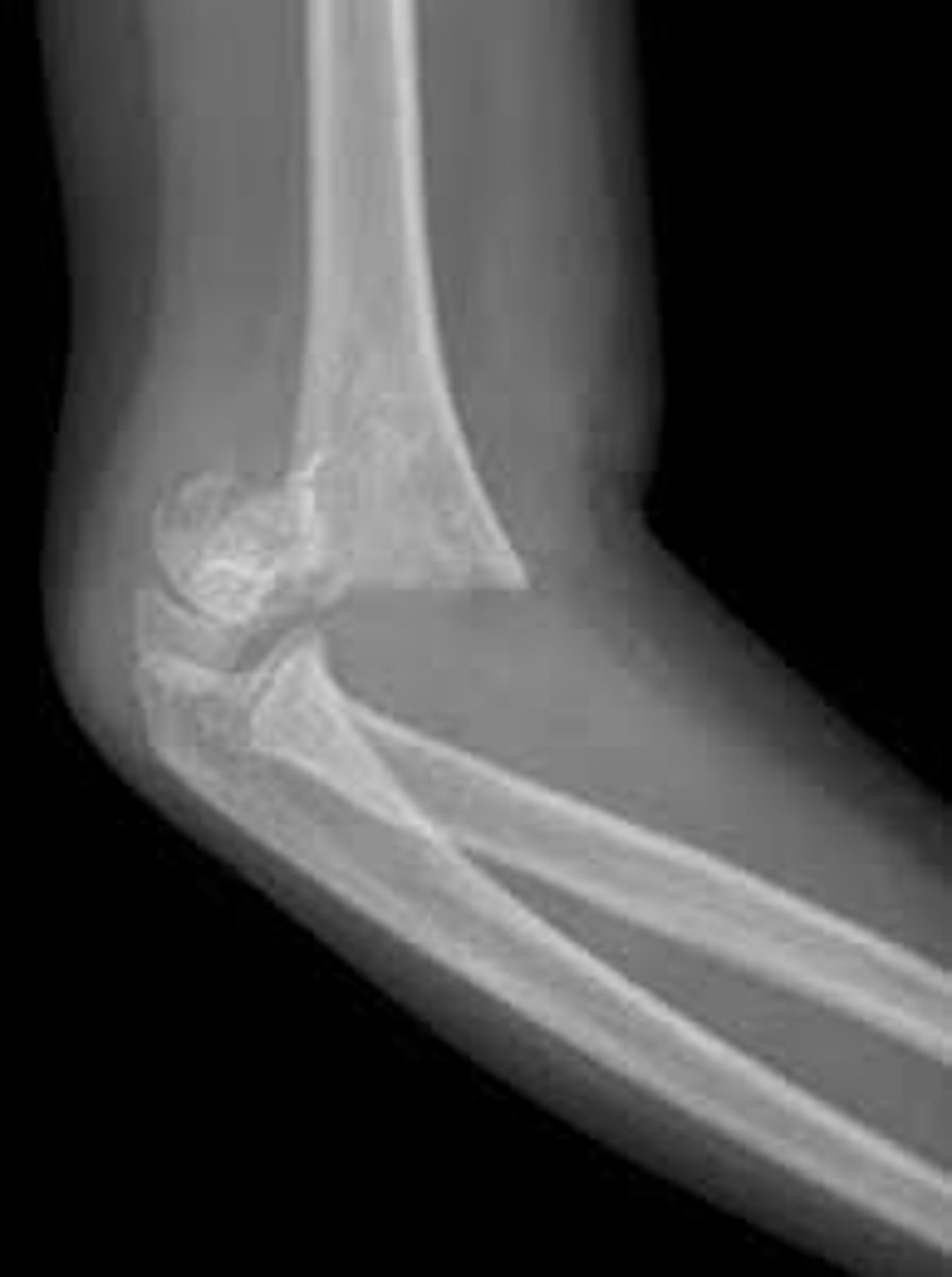 <p>Most common in peds, typically a condylar fracture</p>