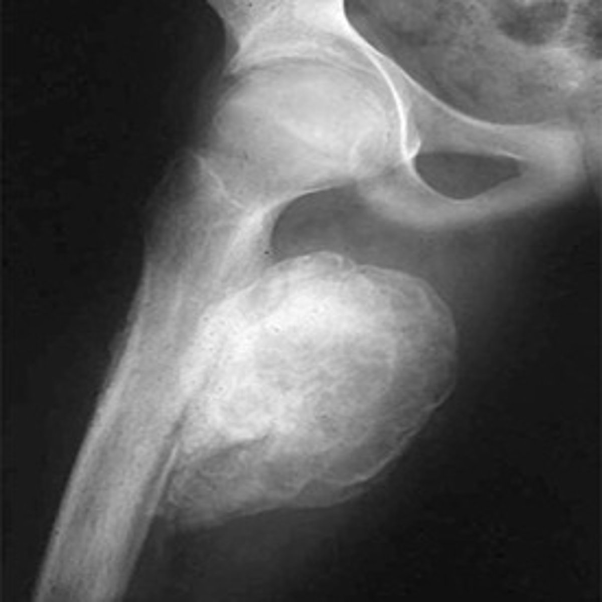 <p>-pain on anterior aspect of distal part of the arm, possible tenderness in muscle belly</p><p>-painful resisted elbow flexion with forearm pronation</p>
