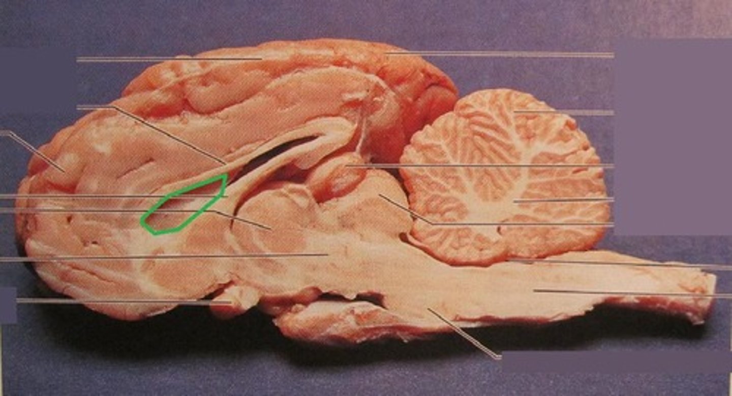<p>one of the ventricles located inside the corpus callosum</p>