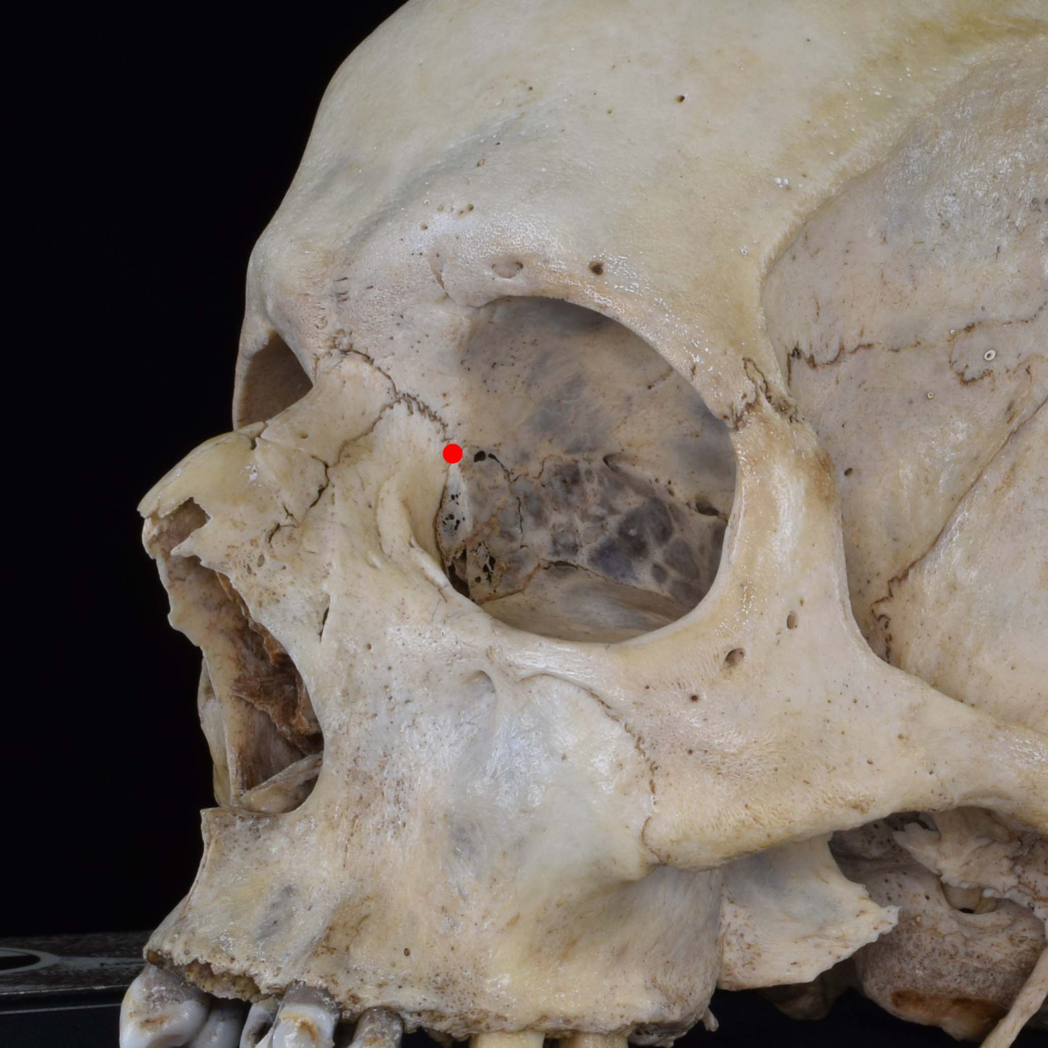 <p>Point where maxillolacrimal suture meets frontal</p>