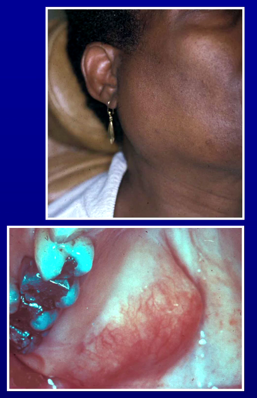 <p>Benign tumour of salivary gland, may recur</p><p>Parotid most common followed by palate</p><p>M=F, 30-60</p>