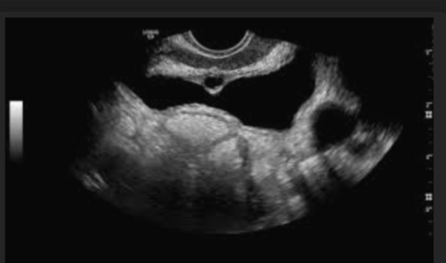 <p>Brunn's Nests</p><p>Chronic cystitis</p>