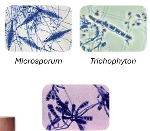 <p>Macroconidia on microscopy → diagnostic</p><p>§ Monomorphic molds</p><ul><li><p>Soil, animals (including pets), humans</p></li><li><p>Contagious</p></li></ul><p>§ Produce keratinases</p><ul><li><p>Break down keratin, allow invasion into lower layers of epidermis</p></li><li><p>ONLY grow on keratinized structures</p></li></ul><p>§ Scaling skin</p><p>§ Loss of hair (can be permanent)</p><p>§ Crumbling nails</p><p>§ Itching</p>