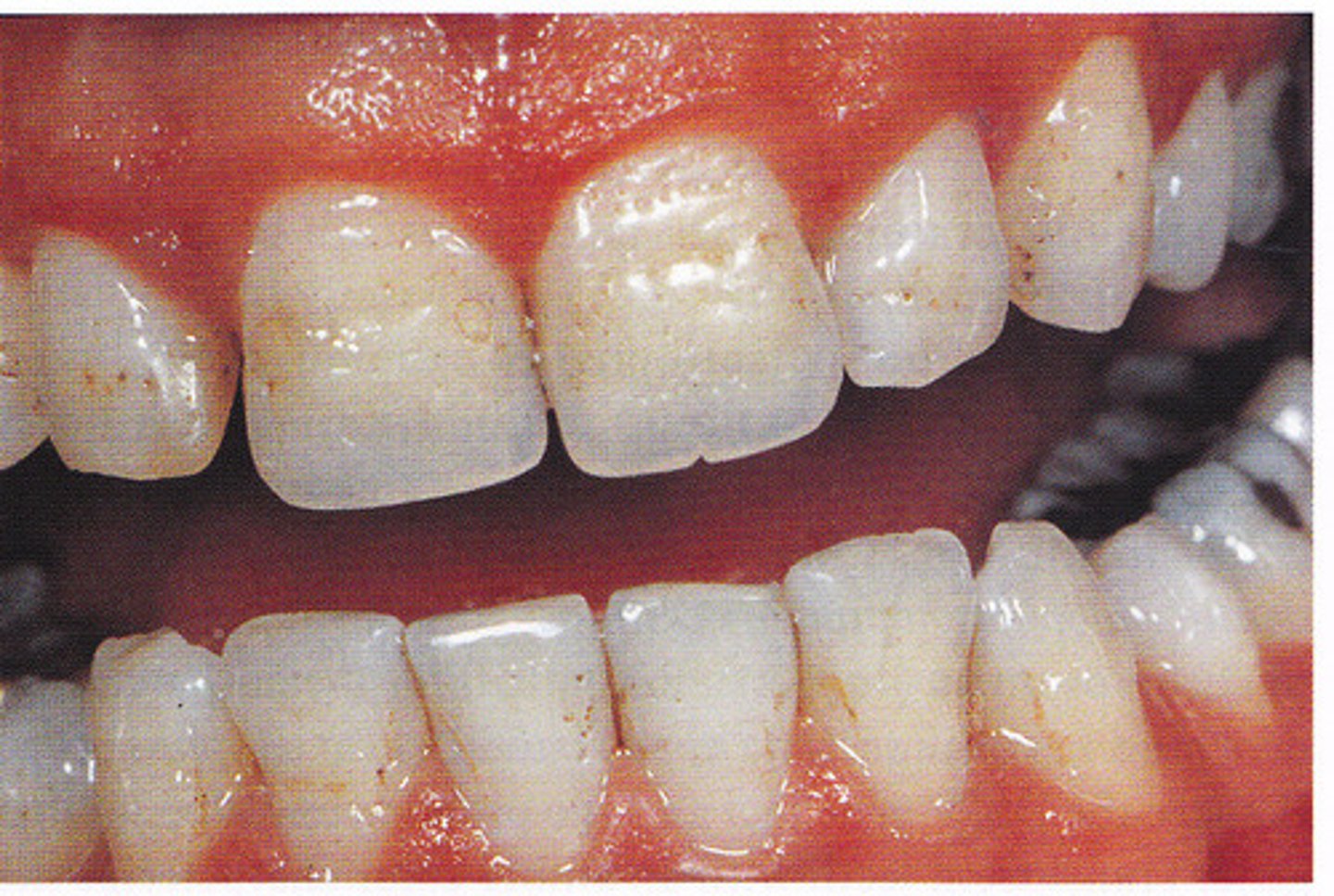 <p>-decreased enamel matrix = thin</p><p>-normal mineralization</p><p>-harder than dentin</p><p>-more radiopaque than dentin</p><p>-pitted, smooth, or rough</p><p>-localized or generalized</p>