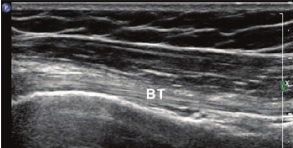 <ul><li><p>comprise multiple individual, longitudinally oriented, parallel collagen fibers that are tightly bundled, resulting in a <u>fibrillary&nbsp;</u>pattern on ultrasound</p></li><li><p>This results in the characteristic <strong>hyperechoic appearance&nbsp;</strong>of tendons when the US beam is oriented 90 degrees to the tendon</p></li></ul><p></p>