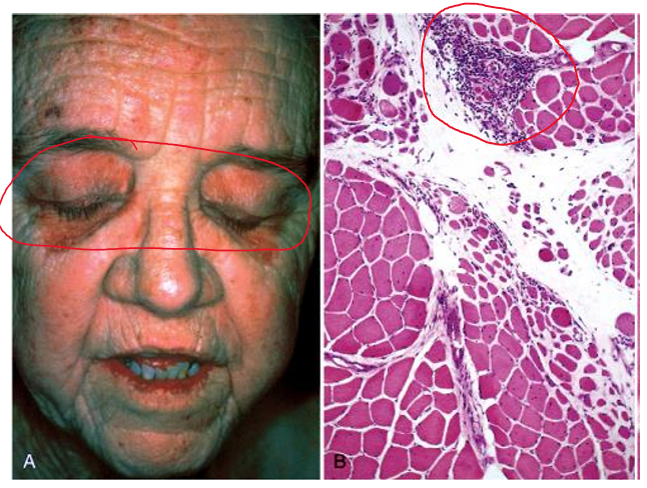 <p>inflammatory myopathy associated with <strong><span style="color: red">damage to small blood vessels </span></strong></p><p>clinical presentations</p><ul><li><p><strong><mark data-color="blue">heliotrope skin rash &amp; proximal muscle disease</mark></strong></p></li><li><p><strong><mark data-color="blue">infiltrates of mononuclear inflammatory cells in the </mark><span><mark data-color="blue">perimysial</mark></span><mark data-color="blue"> connective tissue &amp; around blood vessels</mark></strong></p></li><li><p><strong><mark data-color="green">risk of developing visceral cancers</mark> </strong></p></li></ul>