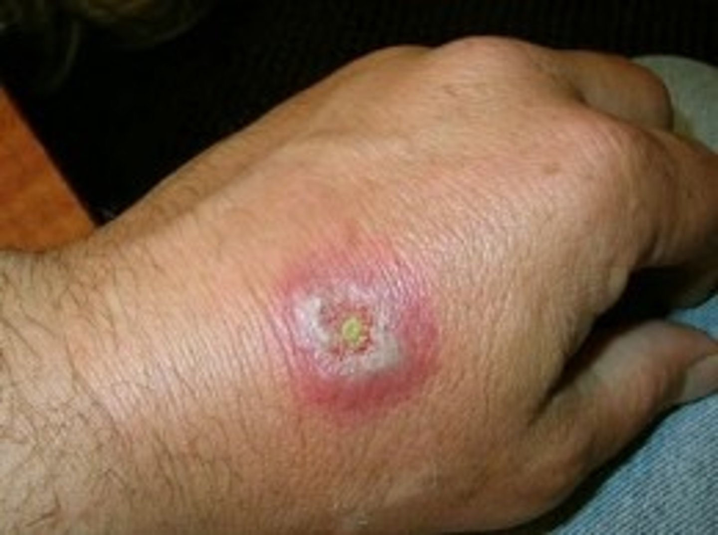 <p>1 hour after bite- pain and numbness spread</p><p>-fever, chills, sweats, vomiitng</p>