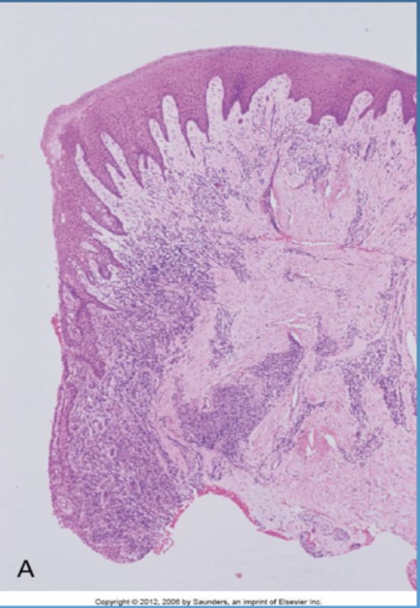 <p>no attachment loss</p><p>blood vessels forming capillary loops to get closer to epithelium</p>