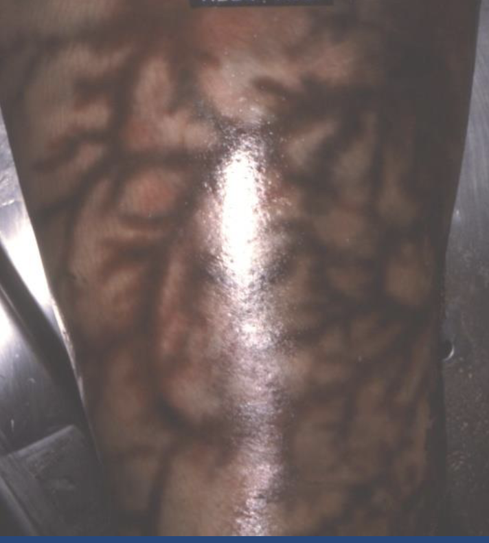 <p><span><span>Hgb with HS along vessels</span></span></p>