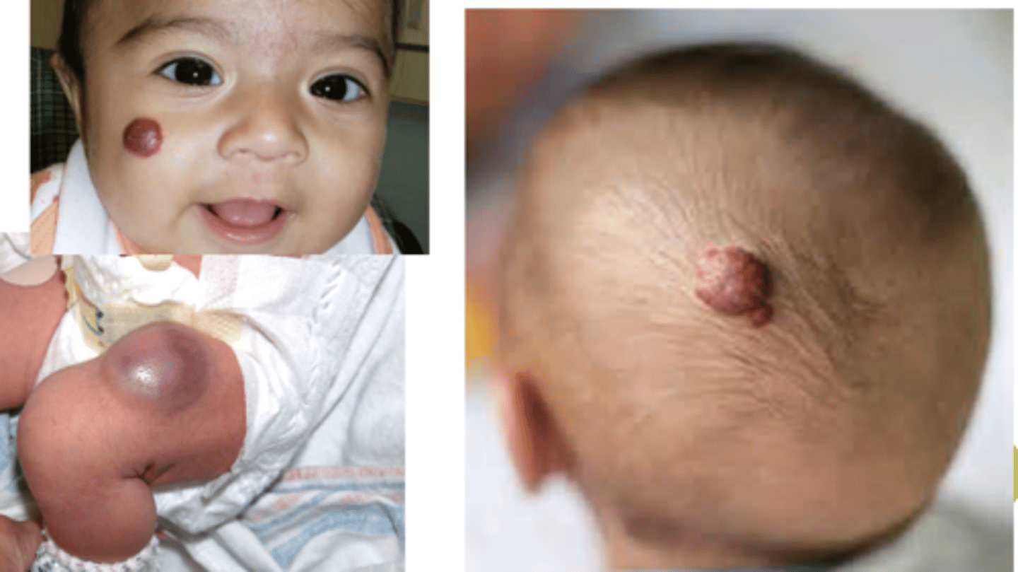 <p>- benign vascular tumor</p><p>- most involute without therapy</p><p>- require intervention if excessive growth occurs or they compromise vision or airway</p>