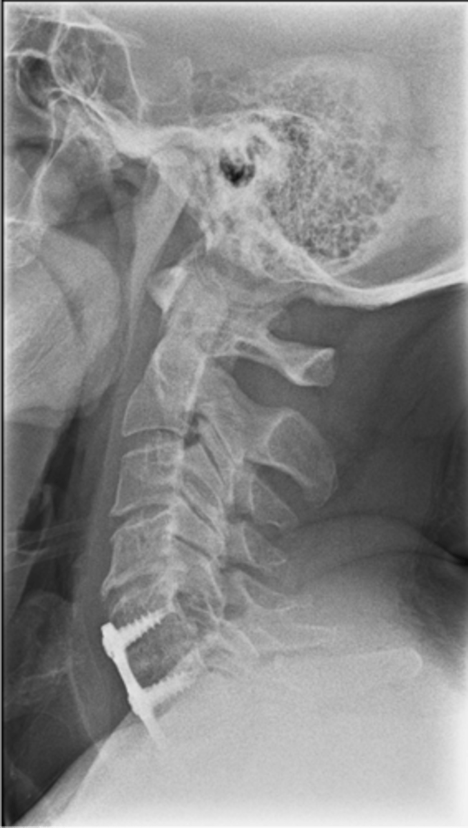 <p>Surgical fusion</p>
