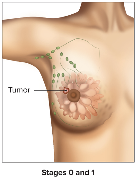 <ul><li><p>Tumor is limited to a very small area</p></li><li><p>Only lymph nodes very close to tissue have cancer cells (if any lymph nodes are involved at all)</p></li></ul>