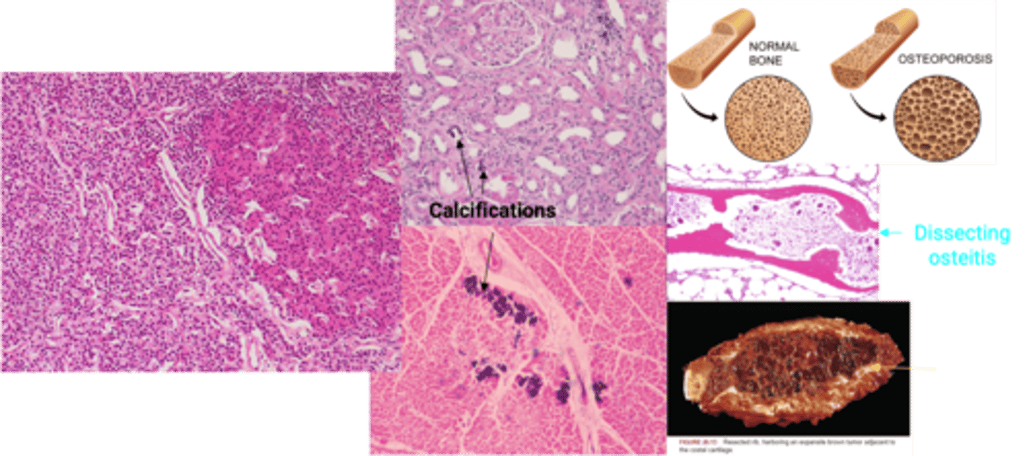 <p>Define Condition:</p><p>ALL 4 glands enlarged (may be asymmetrical)</p><p>-Hx: Less Common than Adenoma</p><p>-Sx/PE:</p><p>&gt; STONES (Hypercalcemia)</p><p>&gt; Polyuria ("THRONE")</p><p>&gt; BONE Pain</p><p>&gt; Constipation/Muscle Weakness (GROANS)</p><p>&gt; AMS (PSYCH OVERTONES)</p><p>-Dx:</p><p>Histo</p><p>&gt; CHIEF CELL Hyperplasia</p><p>&gt; NO RIM of normal tissue</p><p>Labs</p><p>&gt; Increased PTH</p><p>&gt; Increased Serum Ca</p><p>-Prog: (UnTx)</p><p>HPT</p><p>&gt; Osteoporosis (Low Bone Mass)</p><p>&gt; Dissecting Osteitis (More osteoclasts tunnel into center of trabecula)</p><p>&gt; BROWN "TUMOR" Bone Loss (MicroFx and Hemorrhage --&gt; Macrophages cause ingrowth of reparative fibrous tissue --&gt; osteoclasts, hemosiderin laden macrophages ==&gt; Mimic tumor)</p><p>&gt; Osteitis Fibrosa Cystica (Brown Tumor --&gt; Cystic Degeneration + Peritrabecular Fibrosis)</p><p>Hypercalcemia</p><p>&gt; Nephrolithiasis + Nephrocalcinosis</p><p>&gt; Metastatic calcification</p>