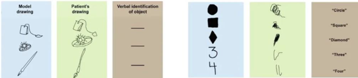 <p><span>failure to recognize an object even though you are able to see it</span></p><p><span>Can come in different forms, but all involve a breakdown in object recognition</span></p>