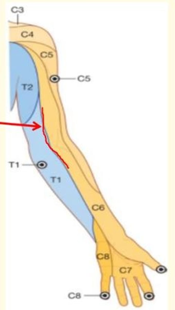 <p>Line of junction of two dermatomes supplied from discontinous spinal levels (e.g., C6 and T1 in this image)</p><p>There is no overlap</p><p>Anterior and posterior axial lines</p>