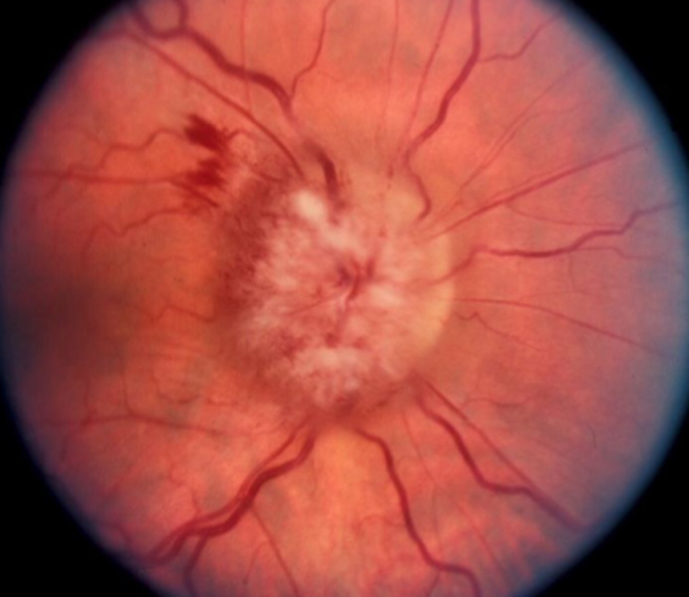 <p>Acute optic disc edema</p>