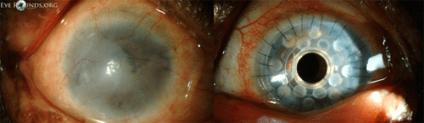 <p>What do we want to consider with ocular surface health during pre-op evaluation?</p>