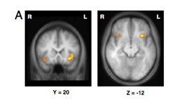 <ul><li><p><span>provided direct evidence for the idea that the PFC performs an attentional role in WM</span></p></li><li><p><span>P held two objects in WM and were subsequently cued either to maintain both objects (non-selective attention condition) or a single object (selective attention condition) in WM</span></p></li><li><p><span>Finally asked to decide whether any of the objects in an array matched the object(s) they were holding in WM</span></p></li><li><p><span>Activation in PFC was greater for the selective condition than the non-selective condition</span></p></li><li><p><span>Connectivity analysis demonstrated that activation in PFC modulated activation in different occipitotemporal regions depending on which stimulus the subject maintained in WM</span></p></li><li><p><span>Combined TMS/fMRI showed that disruption of PFC activity caused distal effects on occipitotemporal activation, thus establishing direction of causation</span></p></li><li><p><span>PFC seems to send an attentional bias signal to sensory-specific regions to enhance processing of the task-relevant object during WM</span></p></li></ul><p></p>