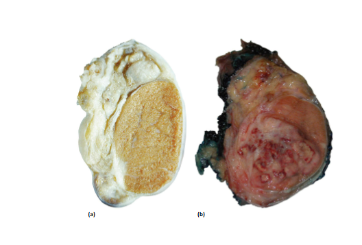 <ul><li><p><span style="background-color: transparent;"><span>Testicular cancer is most common in males between the ages of </span><u><span>15 and 34</span></u><span>.</span></span></p></li><li><p><span style="background-color: transparent;"><span> Routine testicular </span><u><span>self-exams</span></u><span> are recommended for early detection</span></span></p></li></ul><p></p>