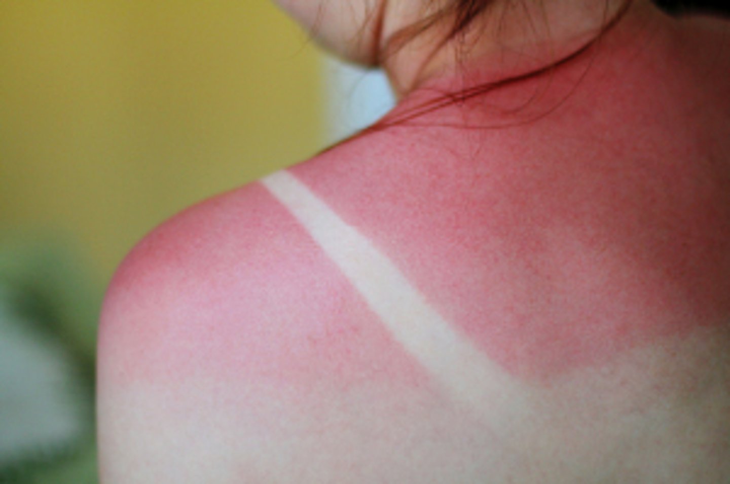 <p>-epidermal damage only</p><p>-localized redness, swelling, and pain</p>