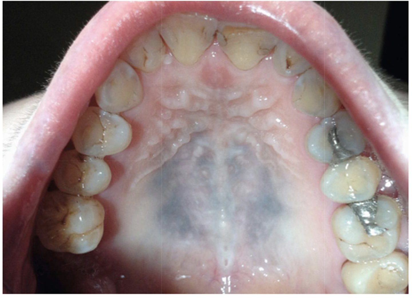 <p>What type of pigmented lesion?</p>