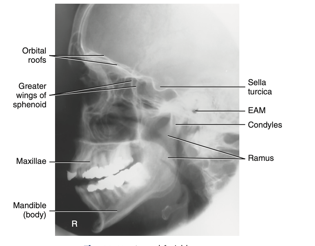<p>How do you <u>critique</u> radiograph of <strong>RT and LT lateral </strong>for <strong>facial bone?</strong></p>