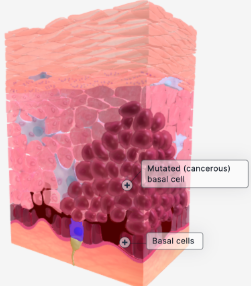 <p>Basal cell carcinoma is a type of skin cancer that originates in the <strong>basal cell layer</strong> of the <strong>epidermis</strong>. The epidermis is the <em>outermost layer of skin.</em></p><p>In basal cell carcinoma, basal cells are mutated and replicate uncontrollably.  These abnormal basal cells form tumors within the skin and on the skin surface</p>