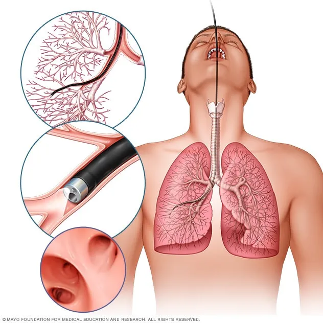 <p>is a medical procedure in which a thin, flexible tube equipped with a camera and light is inserted through the mouth or nose into the airways to visually examine the lungs, obtain tissue samples for biopsy, or perform treatments to diagnose and manage various lung conditions.</p>