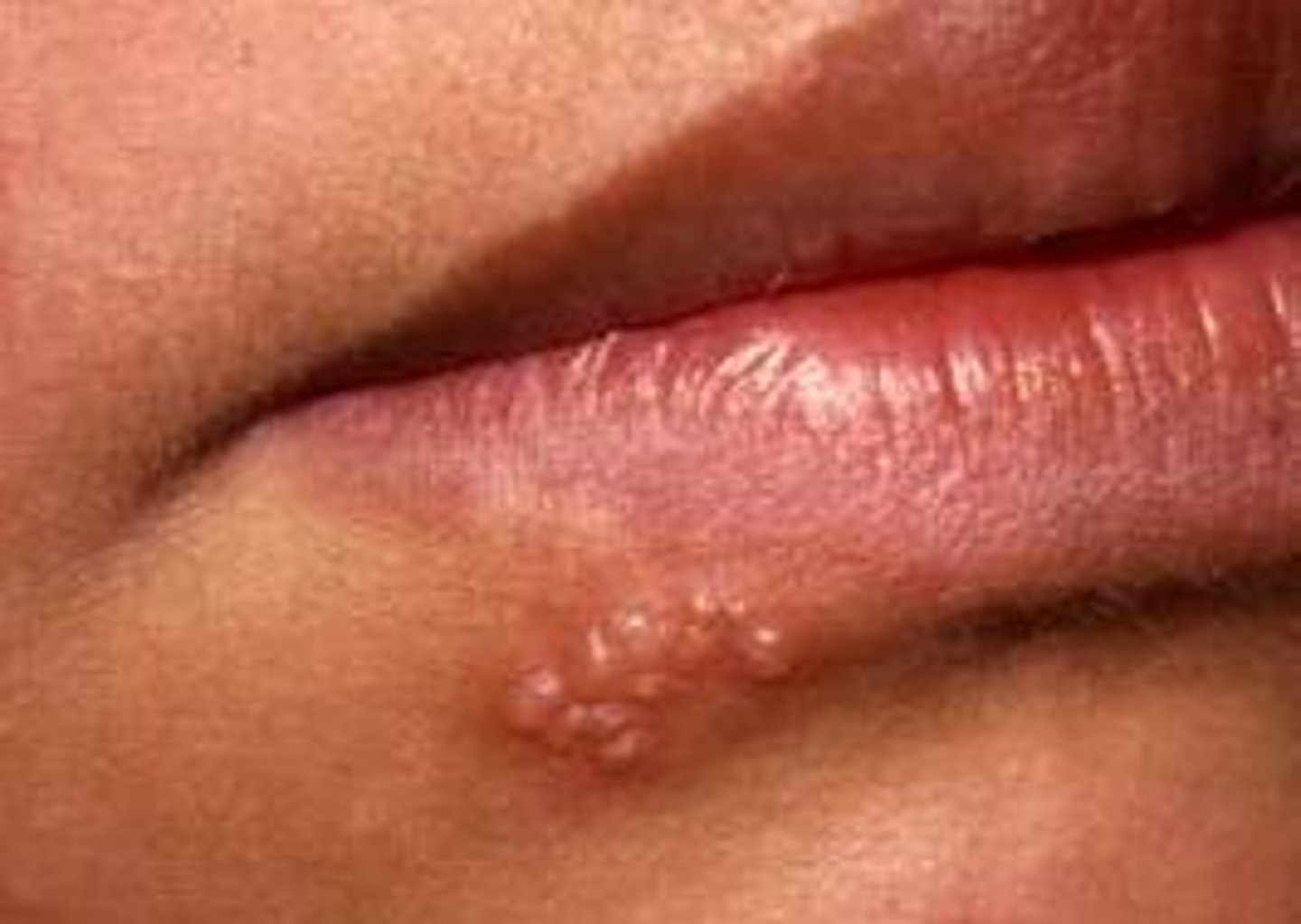 <p>usually seen on vermillion border.</p><p>Herpes labialis/cold sore</p>