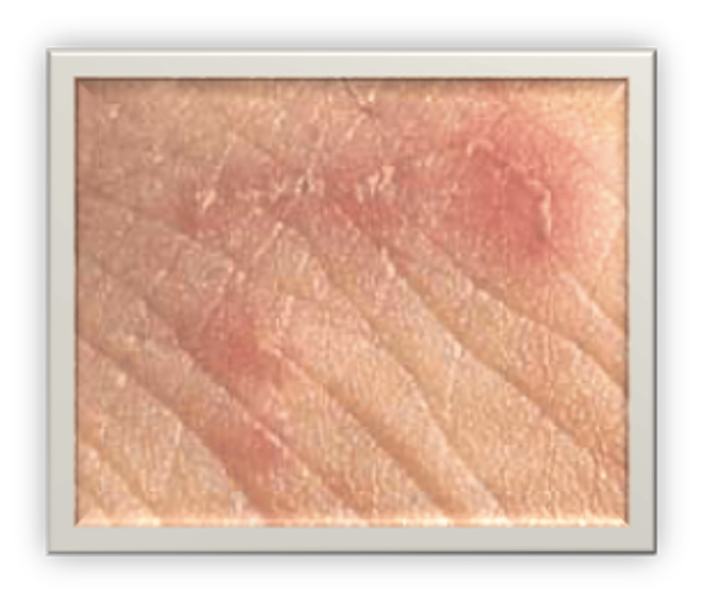 <p>The microscopic scabies mite burrows into the upper layer of the skin where it lives and lays its eggs. The most common symptoms of scabies are intense itching and a pimple-like skin rash.</p>