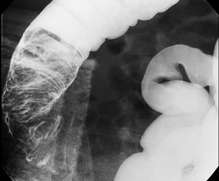 <p>What is intussusception?</p>