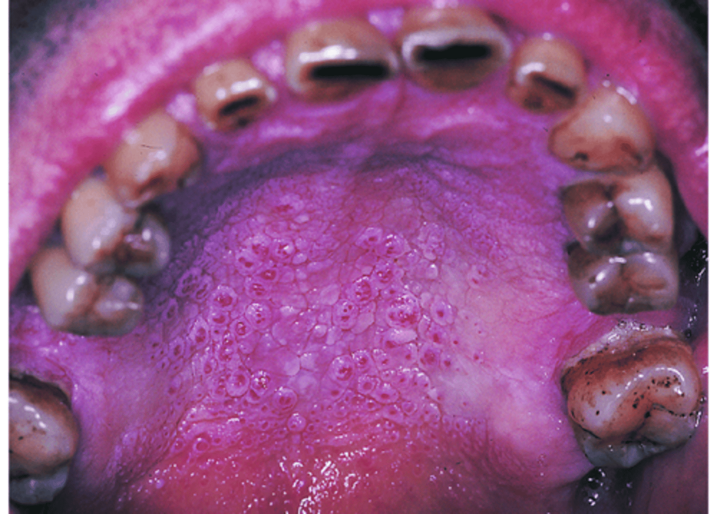<p>Benign lesion typically associated with pipe and/or cigar smoking; May also occur with cigarette smoking</p><p>This benign palatal lesion is typically associated with heavy, long-term pipe and cigar smoking and is caused by heat on the palatal mucosa.</p>
