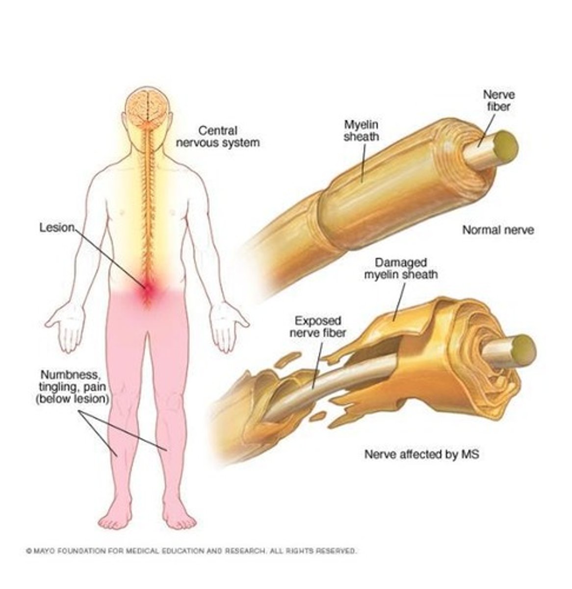 <p>The immune system attacks the myelin, slowing or ceasing impulse conduction.</p>