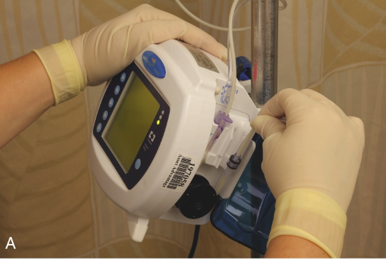 <p><strong>continuous feedings</strong>: via pump. certain mL per hour </p><p><strong>intermittent/ bolus feedings</strong>: specific times during the day </p><ul><li><p>via syringe (GRAVITY. NOT PUSHED). or via pump. </p></li></ul><p>- 240 - 360 mL per feeding </p><p></p><p>included in order: type of formula, volume, rate </p><p>if can, top needs to be cleaned off before opening. </p>