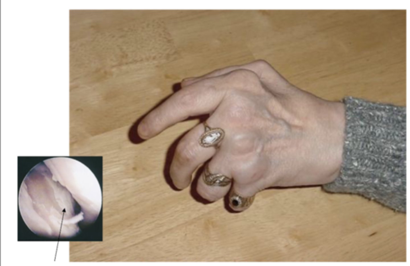 <p>Arthritis is caused by degradation of what type of cartilage?</p>