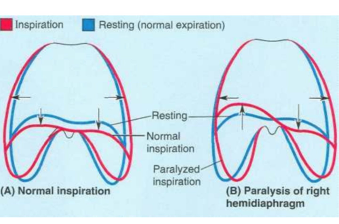 <p>the paralyzed side moves up during inspiration instead of descending, due to negative intrathoracic pressure.</p>