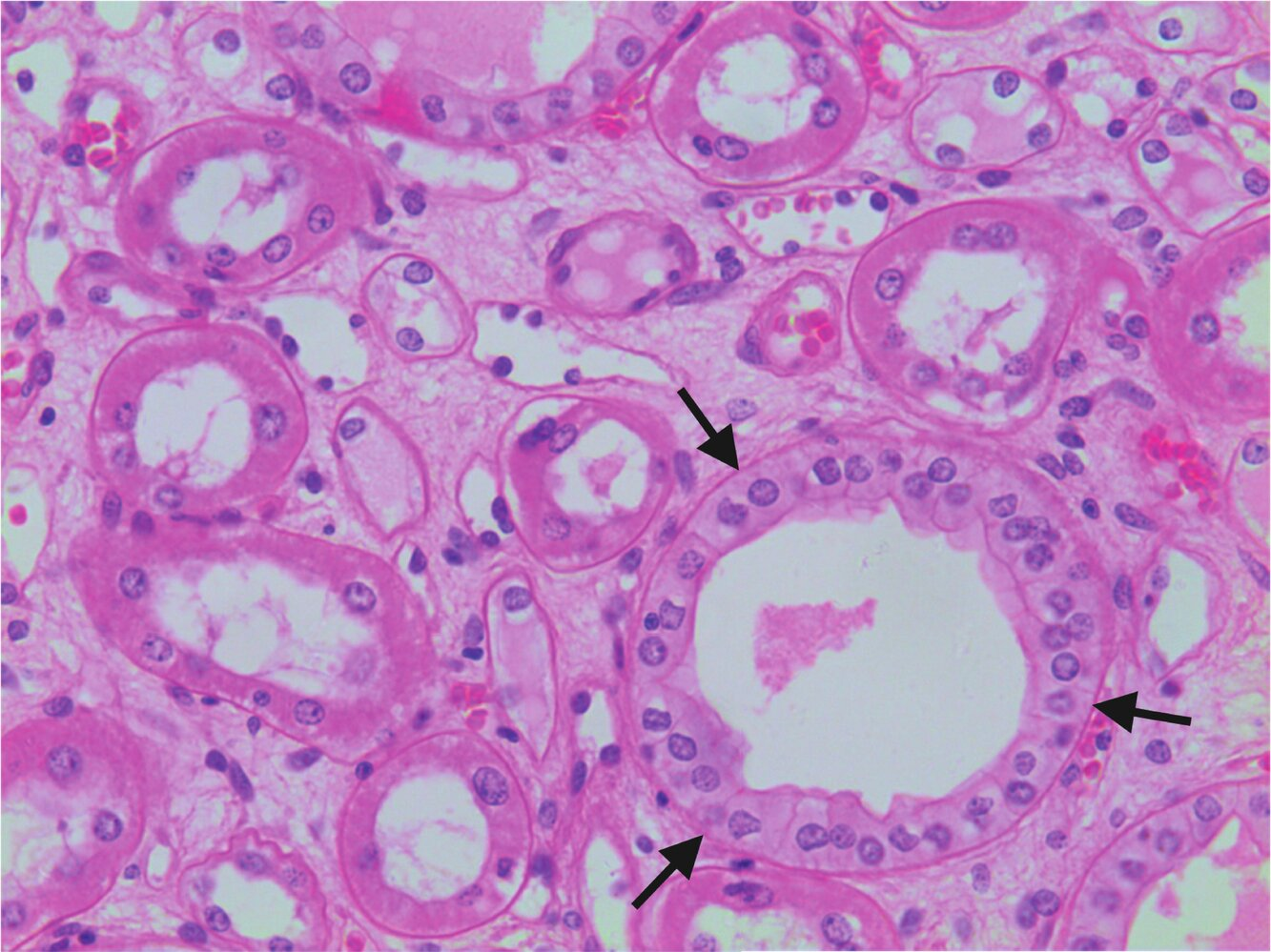 <p>13. Which statement does not apply to the structure marked with arrows in the image?</p><p>A. It is located, among other places, in the renal medulla.</p><p>B. It opens into a papillary duct (Ductus papillaris).</p><p>C. Its epithelium is involved in water reabsorption.</p><p>D. It is influenced by a neuropeptide hormone released from the posterior pituitary.</p><p>E. It develops from the Müllerian ducts.</p>