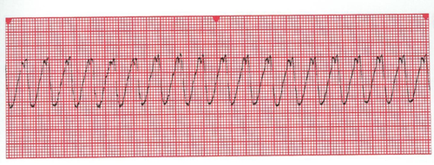 <p>"wide + bizarre"</p><p>qrs are no longer regular</p><p>no p waves</p>