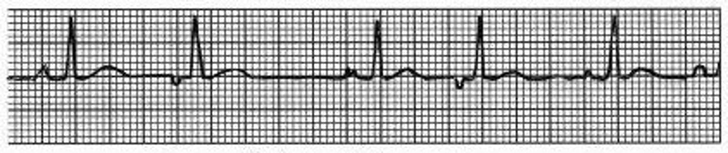 <p>Pacemaker activity "wanders" from SA node to nearby atrial automaticity foci; irregular rhythm w/ at least 3 different p wave morphologies (&amp; HR < 100 bpm)</p>