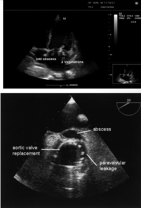 <p>abscesses</p><p>fistula</p><p>changes in prosthetic valve hemodynamics</p><p>valve dehiscence (splitting)&nbsp;</p><p>paravalvular leaks&nbsp;</p>